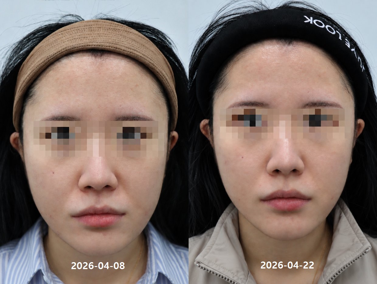 Juvelook Volume 术前术后
