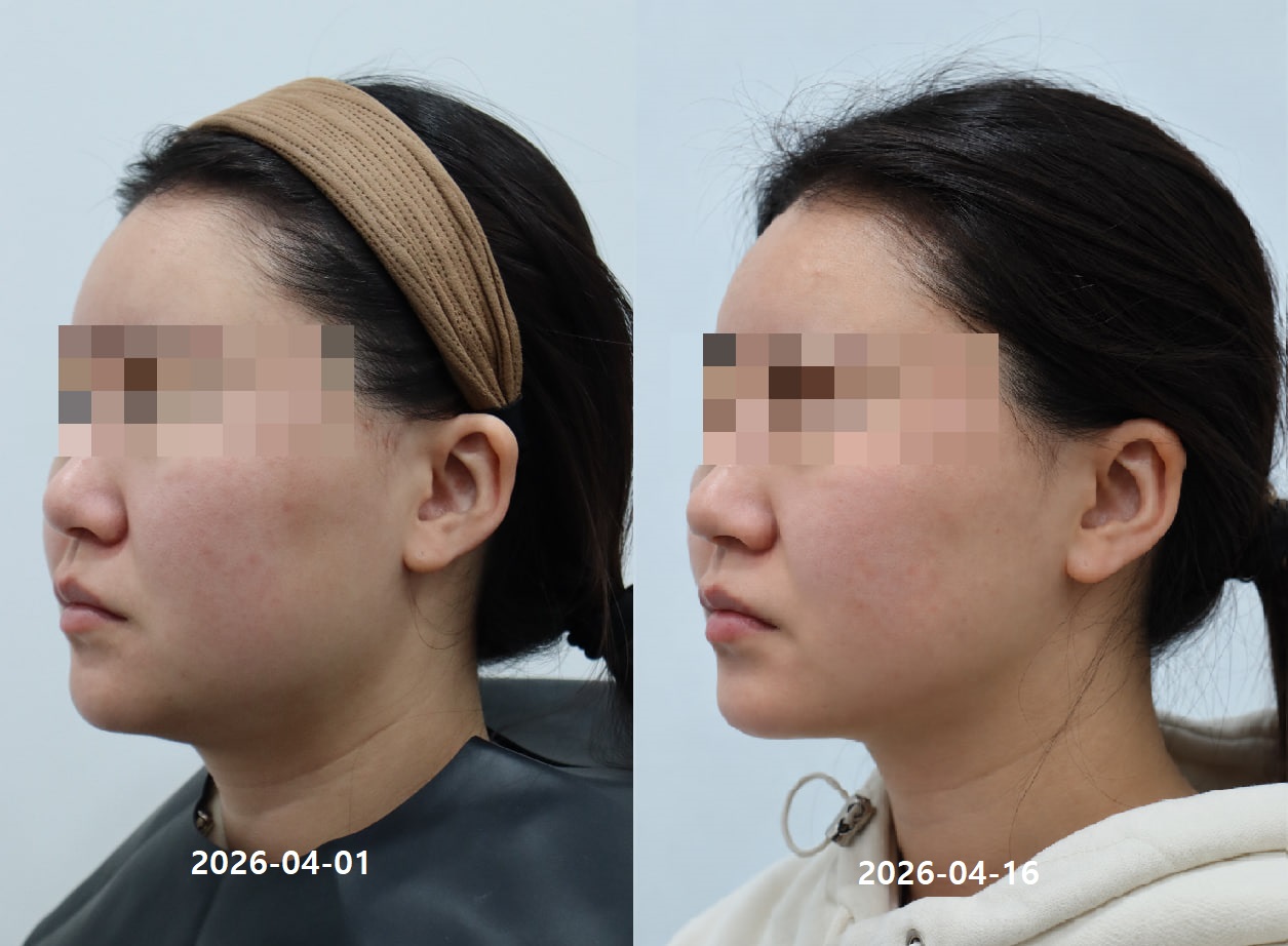 Onda 提拉 术前术后